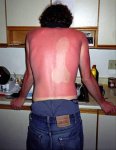 sunburn-pictures-dumpaday-2.jpg